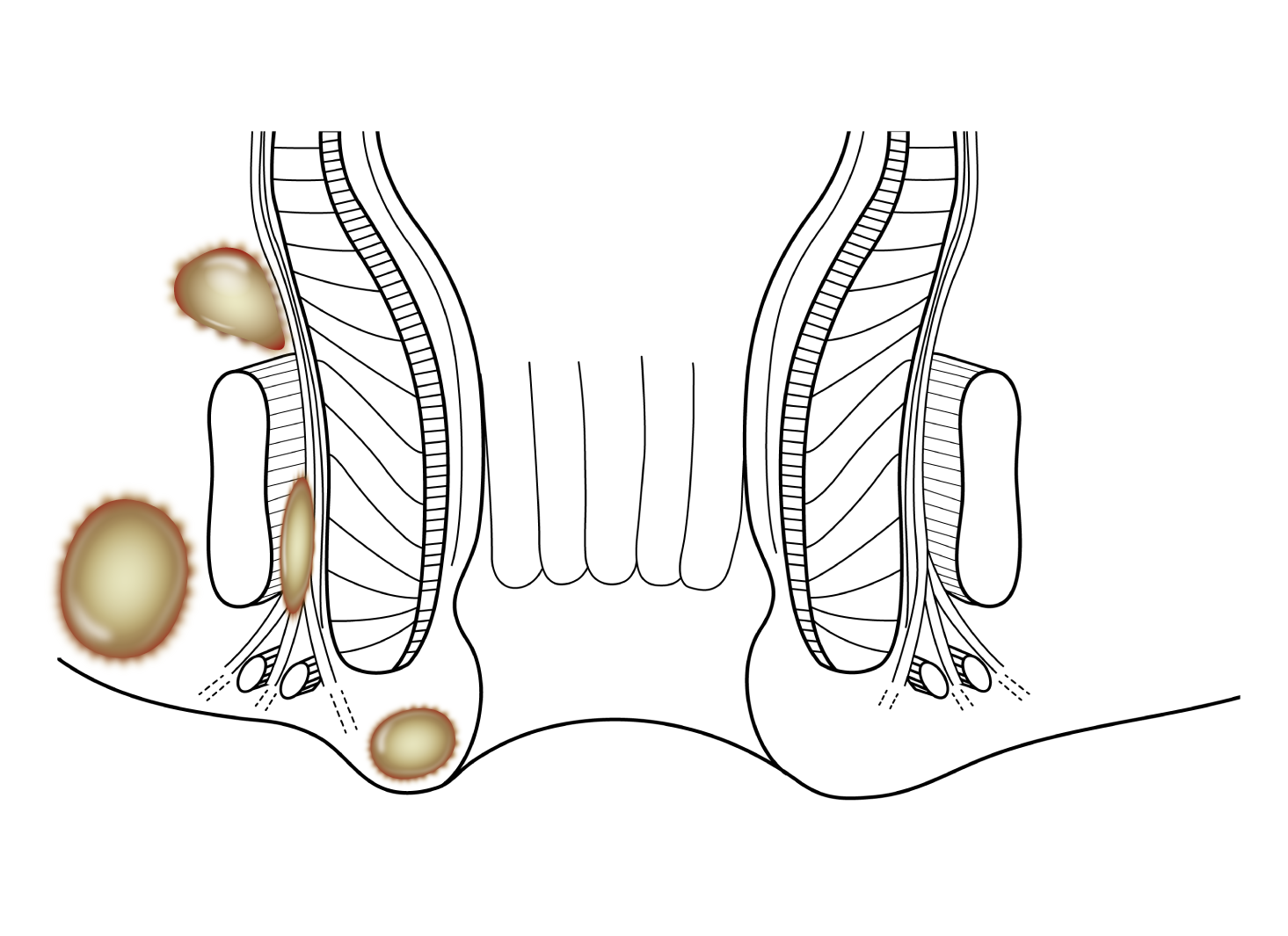 Anal Abscess