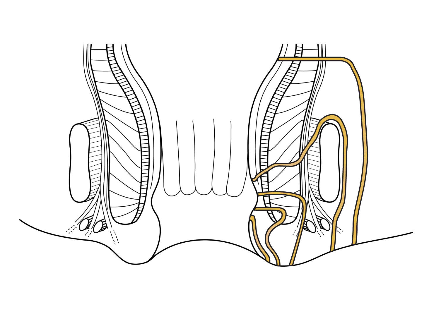 Anal Fistula